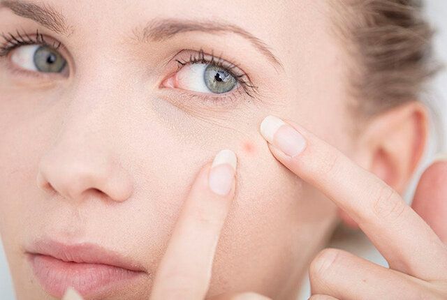 Как избавиться от прыщей на лице: причины появления и советы по уходу